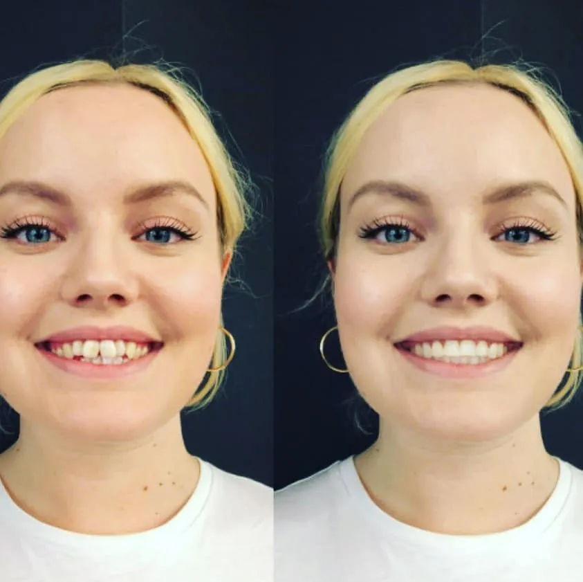 Før og efter tandregulering — patientens smil
